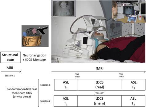 Increased Left Prefrontal Brain Perfusion After MRI Compatible TDCS