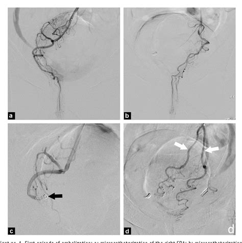 Figure 3 From Embolization Of The Hemorrhoidal Arteries The Emborrhoid