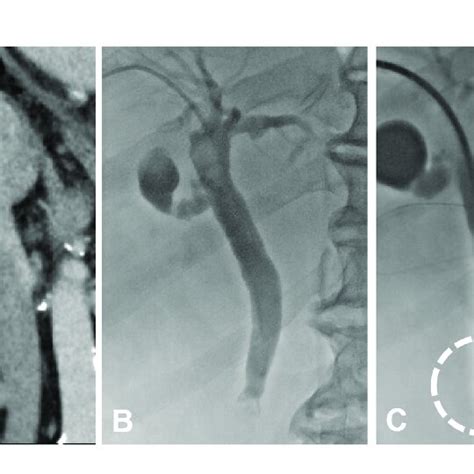 Imaging And Biopsy Of The Biliary Obstruction A Coronal Enhanced