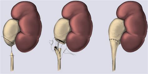 What is Ureteropelvic Junction Obstruction?