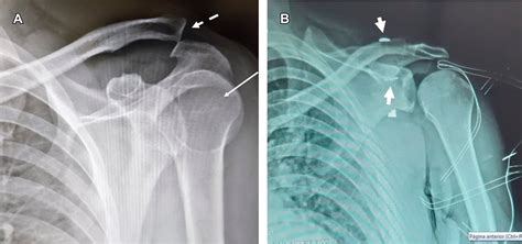 Posterior Glenohumeral Dislocation Associated With Grade III