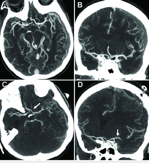 Development Of Cerebral Vasospasm After Subdural Hematoma Evacuation