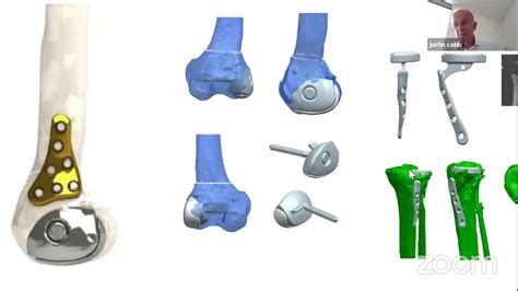 3d Printing In Orthopaedic Surgery Youtube