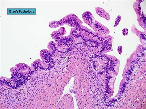 Qiaos Pathology Mucinous Borderline Tumor Of Ovary Intestinal Type