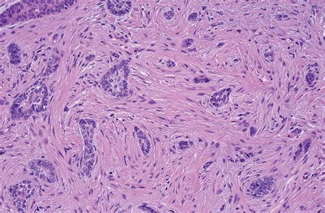 Morpheaform Basal Cell Carcinoma Histology