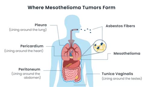 Mesothelioma A Bioinformatics Perspective On Diagnosis Prognosis And