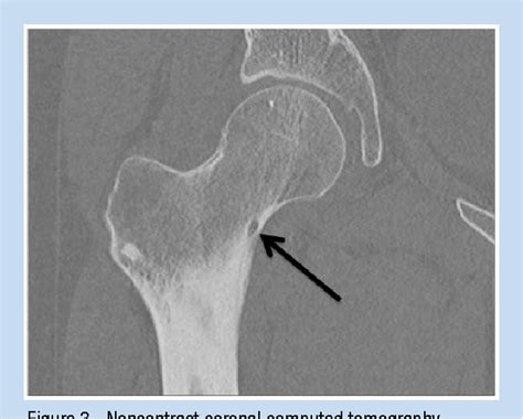 Figure From Osteoid Osteoma Of The Femoral Neck In Athletes