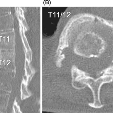 Autologous iliac bone grafting: (A) harvested iliac bone block and ...