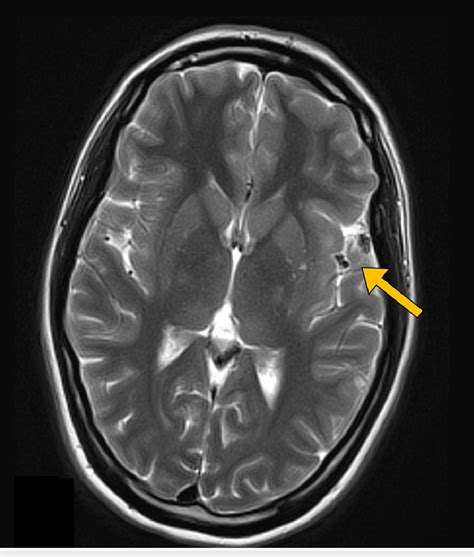 T2 Weighted MRI Showing Susceptibility Artifact Arrow In Keeping With