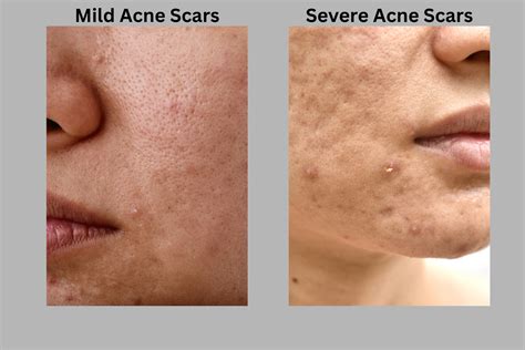 Erase Acne Scars With Prp Microneedling Taviemd Medspa