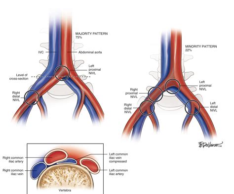 Iliocaval And Femoral Venous Occlusive Disease Clinical Tree