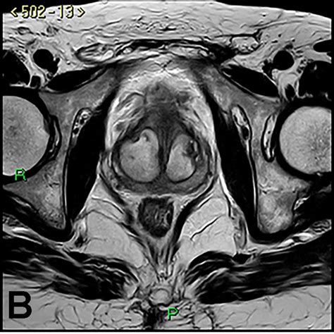 Pdf Transperineal Laser Ablation For Percutaneous Treatment Of Benign Prostatic Hyperplasia A