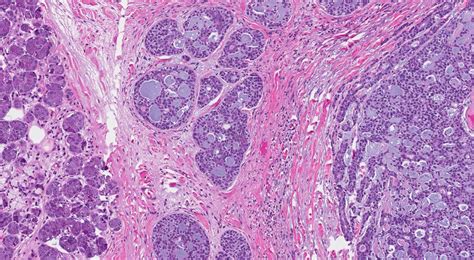 Adenoid cystic carcinoma | Ottawa Atlas of Pathology