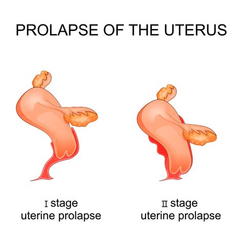 How To Heal A Uterine Prolapse Your Sacred Pelvis Uterine Prolapse