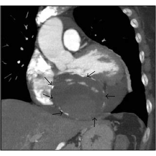 Multidetector Computed Tomography Mdct Multiplanar Reconstruction