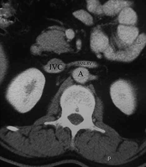 Opening Of The Circumaortic Paslrv Vein Of Case 1 Into The Ivc A