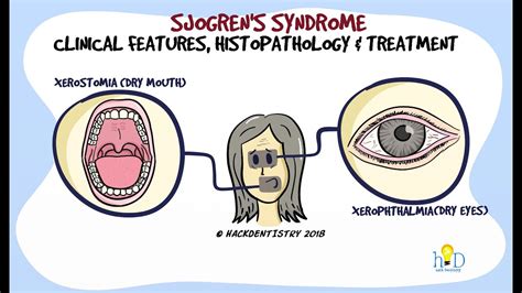 Sjogrens Syndrome Part 2 Clinical Features And Histopathology