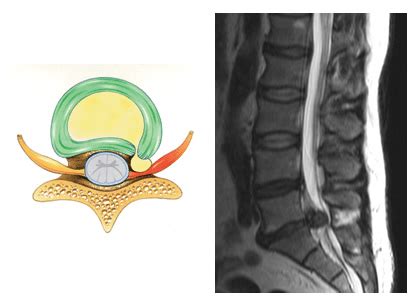 Slipped Disc: Prolapsed Disc Slipped Disc Symptoms