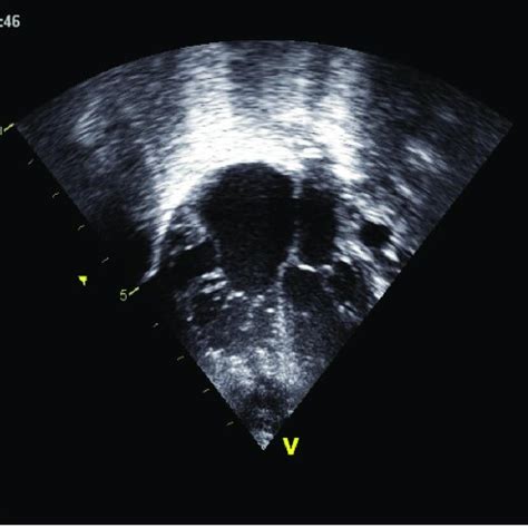 A Echocardiographic Apical Four Chamber View Showing Dilated Right