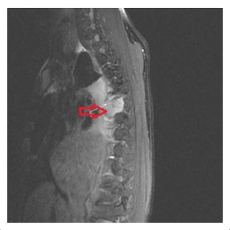 Magnetic Resonance Imaging Of The Thoracic Spine Showing Right Download Scientific Diagram