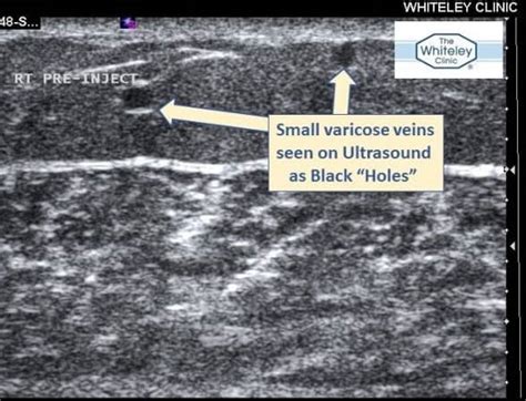 Ultrasound Guided Foam Sclerotherapy Treatment The Whiteley Clinic