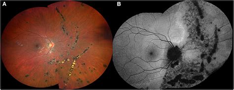 Frontiers Key Multimodal Fundus Imaging Findings To Recognize