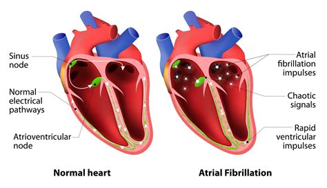 atrial fibrillation ad instruments uk