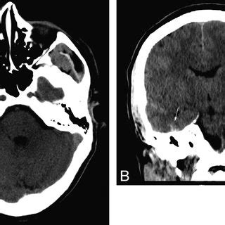 A, Minimal thickening of the anterior falx (arrow ) is not... | Download Scientific Diagram