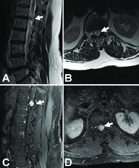 Sagittal A And Axial B Mri T2 Scans Demonstrating An Intradural