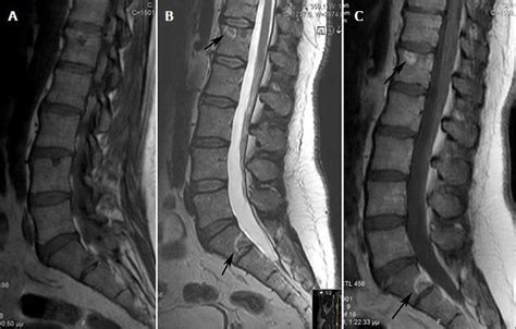 Mri Lumbar Spine Labeled