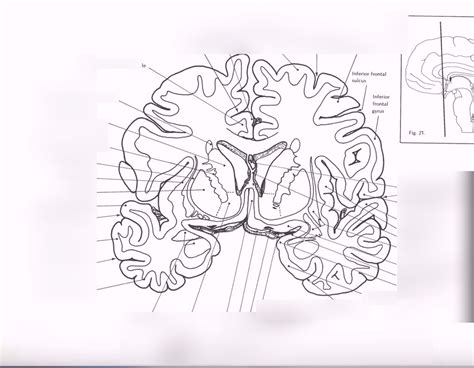 Neuroanatomy Quiz Coronal Section Diagram Quizlet