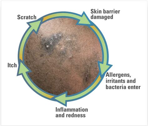 eczema  skin  color hold patient education