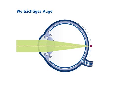 Weitsichtigkeit Augen Laser Center Dr Brodehl