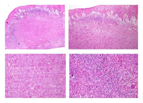 Peripheral Giant Cell Granuloma Vs Pyogenic Granuloma