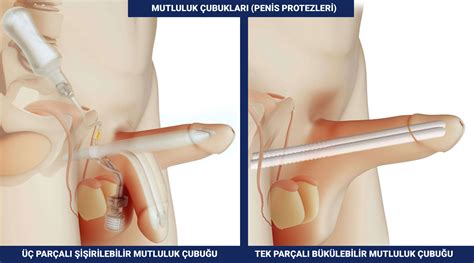 Penil Protez Çeşitleri Nelerdir Penis Protezi Çeşitleri