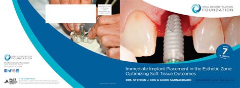 Pdf Immediate Implant Placement In The Esthetic Zone · Immediate