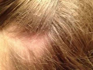 Lice Nits In Blonde Hair - Caraway Seeds Health Benefits