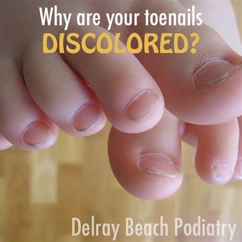 Why do I have discolored toenails? - Delray Beach Podiatry