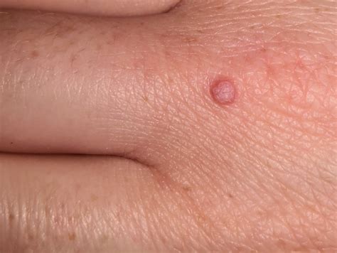 Common Warts