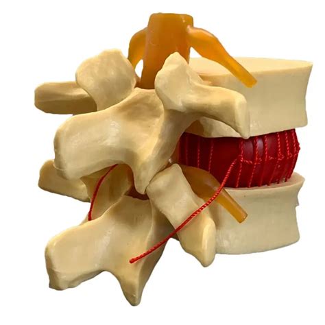 Anatomik Insan Lomber Vertebra Dejeneratif Lomber Disk Herniasyon G