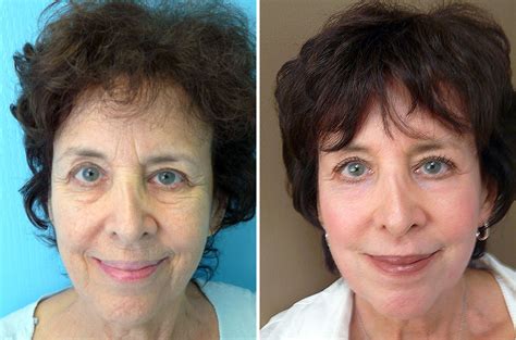 Non Surgical Facial Rejuvenation Dr Oneil