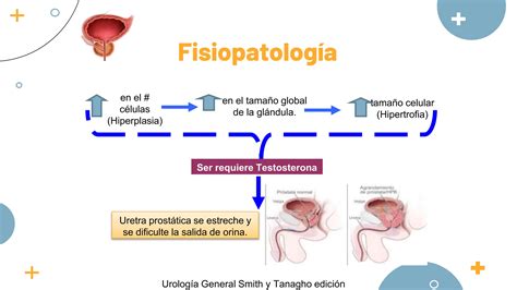 Hiperplasia Prost Tica Benigna Y C Ncer De Pr Stata Ppt