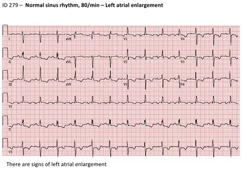 Stepwise Interpretation Of Ecg Id279