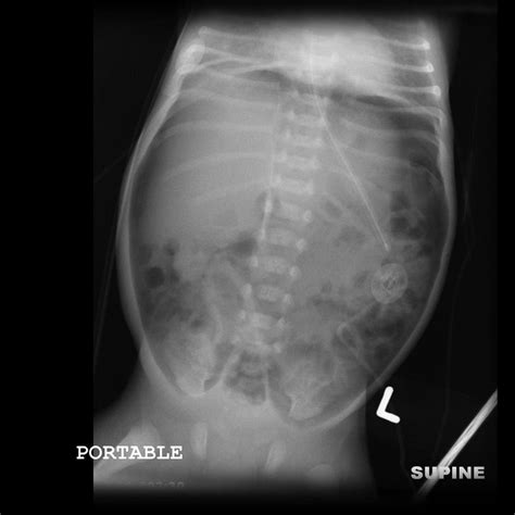 The Abdominal Xray A Relic Or A Reliable Tool — Taming The Sru