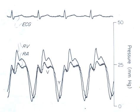 Venous Pulse