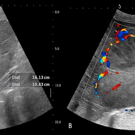 Hepatic Epithelioid Hemangioendothelioma Ultrasound Showing A Large