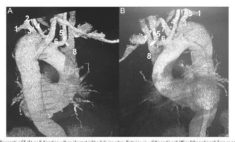 Figure 1 From Repair Of Complicated Type B Dissection With An Aberrant