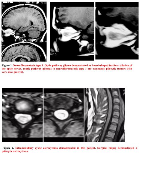 Short Case Neurofibromatosis Type 1 Pdf