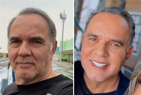 Humberto Martins faz harmonização facial e exibe novo visual Super