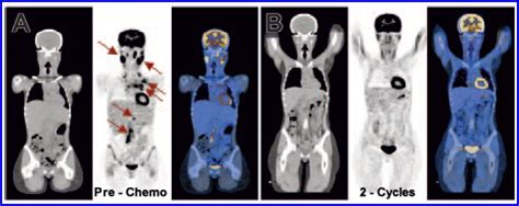 Pet Imaging In Oncology